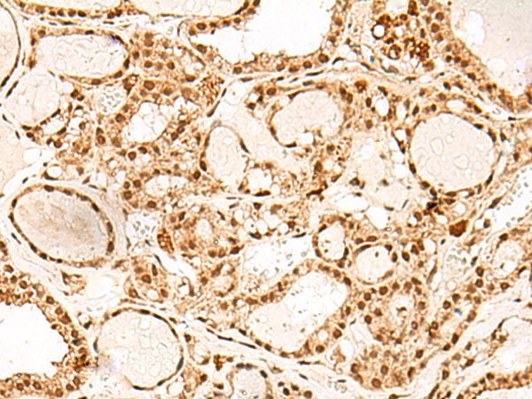 Immunohistochemistry of paraffin-embedded Human thyroid cancer tissue  using PAF1 Polyclonal Antibody at dilution of 1:55(×200)