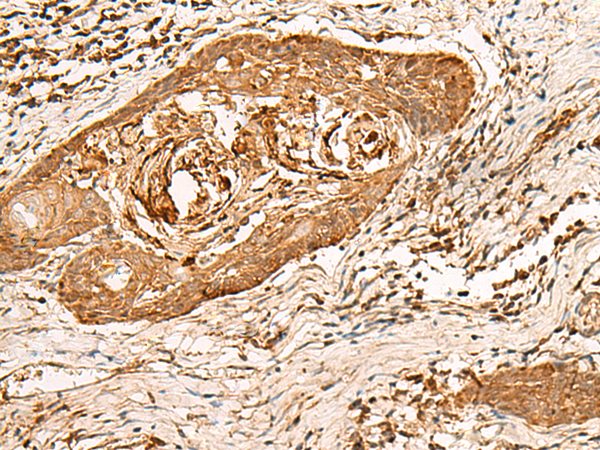 Immunohistochemistry of paraffin-embedded Human esophagus cancer tissue  using HIRIP3 Polyclonal Antibody at dilution of 1:60(×200)