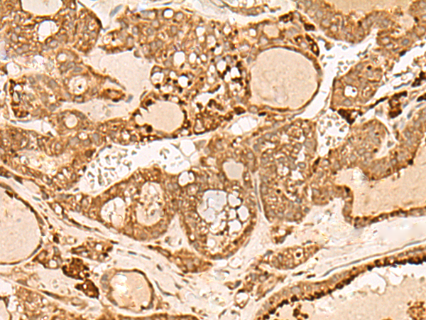 Immunohistochemistry of paraffin-embedded Human thyroid cancer tissue  using HIRIP3 Polyclonal Antibody at dilution of 1:60(×200)
