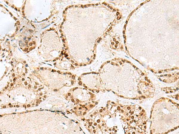 Immunohistochemistry of paraffin-embedded Human thyroid cancer tissue  using GTF3C2 Polyclonal Antibody at dilution of 1:45(×200)