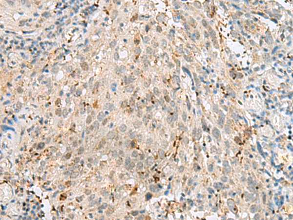 Immunohistochemistry of paraffin-embedded Human cervical cancer tissue  using GTF3C2 Polyclonal Antibody at dilution of 1:45(×200)