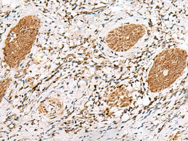Immunohistochemistry of paraffin-embedded Human esophagus cancer tissue  using NUP58 Polyclonal Antibody at dilution of 1:60(×200)