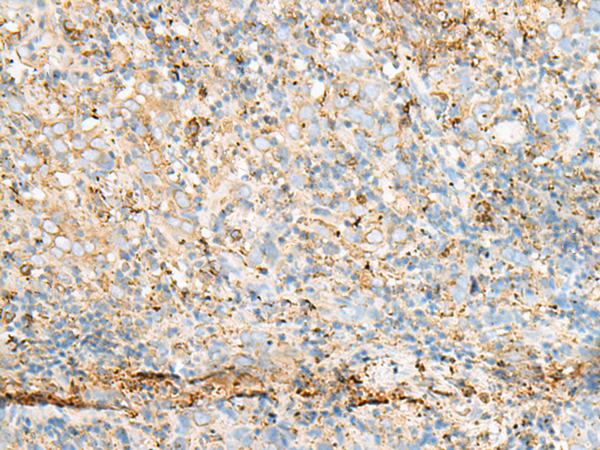 Immunohistochemistry of paraffin-embedded Human cervical cancer tissue  using PDIA4 Polyclonal Antibody at dilution of 1:50(×200)