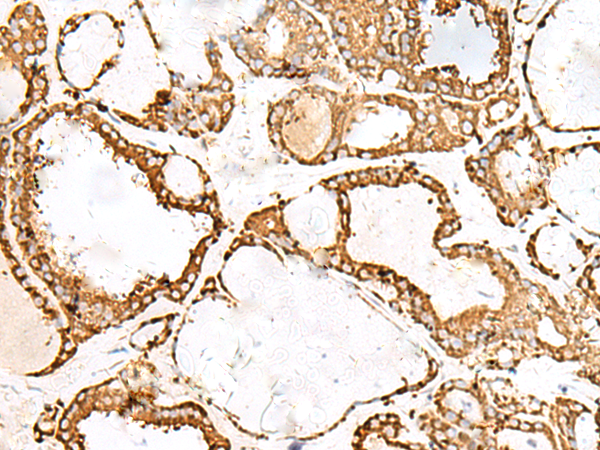 Immunohistochemistry of paraffin-embedded Human thyroid cancer tissue  using PDIA4 Polyclonal Antibody at dilution of 1:50(×200)