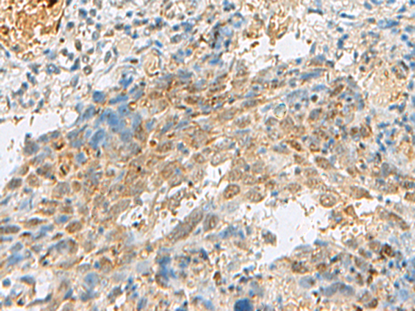 Immunohistochemistry of paraffin-embedded Human cervical cancer tissue  using PRPF3 Polyclonal Antibody at dilution of 1:30(×200)