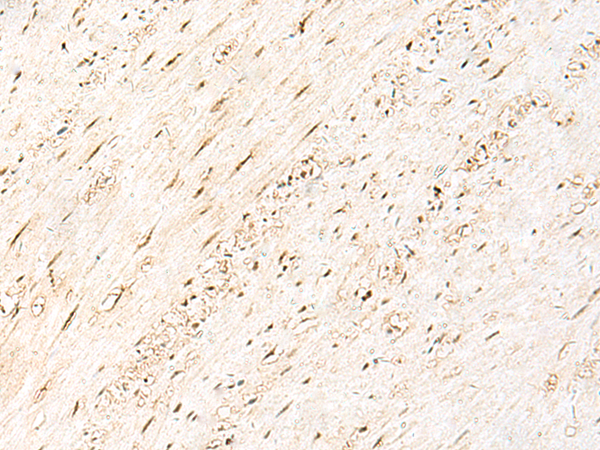 Immunohistochemistry of paraffin-embedded Human colorectal cancer tissue  using PRPF3 Polyclonal Antibody at dilution of 1:30(×200)