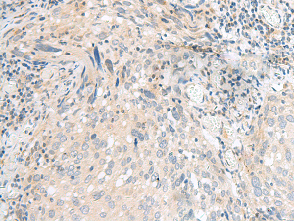 Immunohistochemistry of paraffin-embedded Human cervical cancer tissue  using CALCOCO1 Polyclonal Antibody at dilution of 1:40(×200)