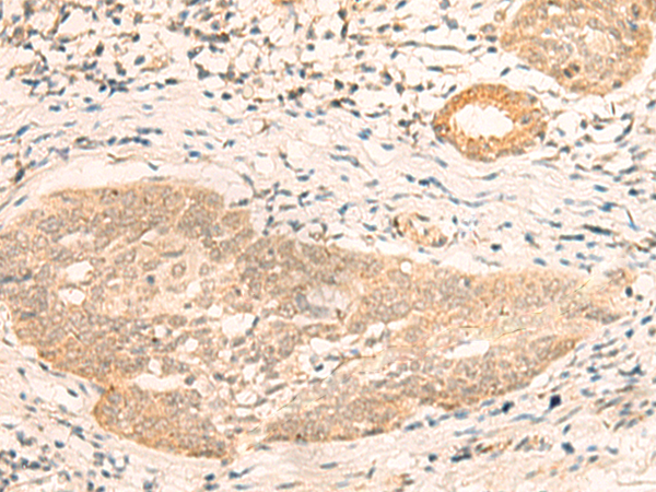 Immunohistochemistry of paraffin-embedded Human esophagus cancer tissue  using CALCOCO1 Polyclonal Antibody at dilution of 1:40(×200)
