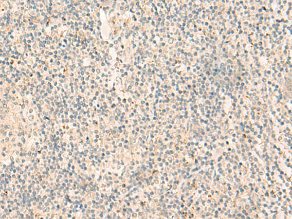 Immunohistochemistry of paraffin-embedded Human tonsil tissue  using NGEF Polyclonal Antibody at dilution of 1:35(×200)