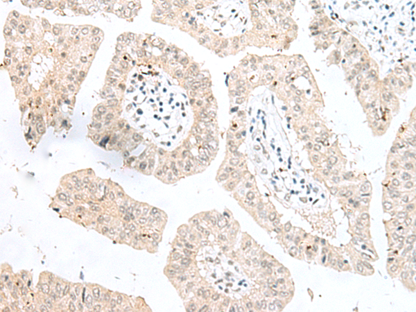 Immunohistochemistry of paraffin-embedded Human liver cancer tissue  using NGEF Polyclonal Antibody at dilution of 1:35(×200)