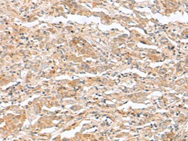 Immunohistochemistry of paraffin-embedded Human cervical cancer tissue  using TTC12 Polyclonal Antibody at dilution of 1:40(×200)