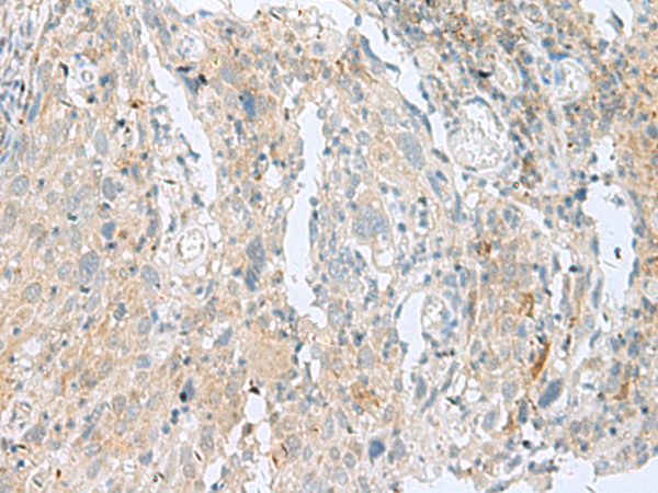 Immunohistochemistry of paraffin-embedded Human cervical cancer tissue  using SLC26A3 Polyclonal Antibody at dilution of 1:35(×200)