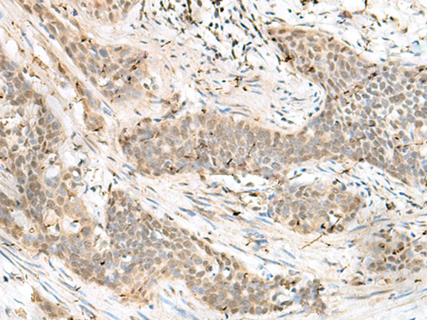 Immunohistochemistry of paraffin-embedded Human esophagus cancer tissue  using LIG4 Polyclonal Antibody at dilution of 1:60(×200)