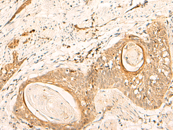 Immunohistochemistry of paraffin-embedded Human esophagus cancer tissue  using EIF3C Polyclonal Antibody at dilution of 1:35(×200)