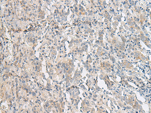 Immunohistochemistry of paraffin-embedded Human cervical cancer tissue  using PCSK5 Polyclonal Antibody at dilution of 1:50(×200)