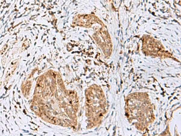 Immunohistochemistry of paraffin-embedded Human esophagus cancer tissue  using TEX11 Polyclonal Antibody at dilution of 1:50(×200)