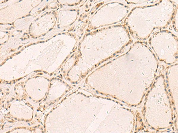 Immunohistochemistry of paraffin-embedded Human thyroid cancer tissue  using RFX6 Polyclonal Antibody at dilution of 1:50(×200)