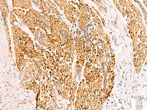 Immunohistochemistry of paraffin-embedded Human esophagus cancer tissue  using RFX6 Polyclonal Antibody at dilution of 1:50(×200)