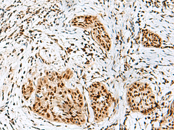 Immunohistochemistry of paraffin-embedded Human esophagus cancer tissue  using RBM10 Polyclonal Antibody at dilution of 1:50(×200)