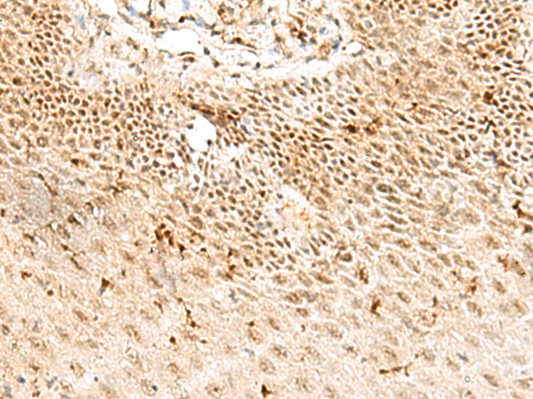 Immunohistochemistry of paraffin-embedded Human tonsil tissue  using RBM10 Polyclonal Antibody at dilution of 1:50(×200)