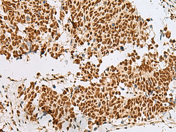 Immunohistochemistry of paraffin-embedded Human lung cancer tissue  using RBM12 Polyclonal Antibody at dilution of 1:50(×200)