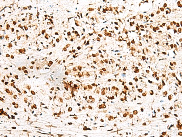 Immunohistochemistry of paraffin-embedded Human prost ate cancer tissue  using RBM12 Polyclonal Antibody at dilution of 1:50(×200)