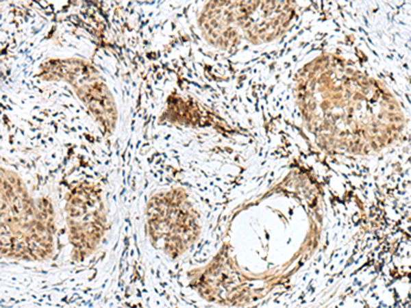 Immunohistochemistry of paraffin-embedded Human esophagus cancer tissue  using RBM15 Polyclonal Antibody at dilution of 1:50(×200)