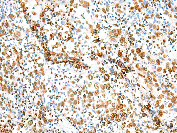 Immunohistochemistry of paraffin-embedded Human cervical cancer tissue  using TCOF1 Polyclonal Antibody at dilution of 1:50(×200)