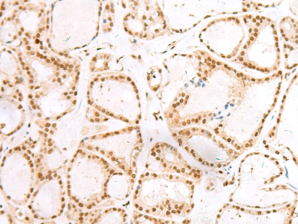 Immunohistochemistry of paraffin-embedded Human thyroid cancer tissue  using TCOF1 Polyclonal Antibody at dilution of 1:50(×200)