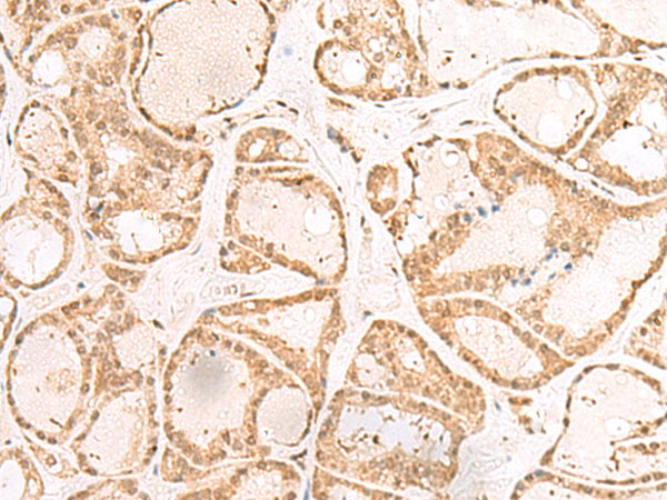 Immunohistochemistry of paraffin-embedded Human thyroid cancer tissue  using RBM19 Polyclonal Antibody at dilution of 1:30(×200)