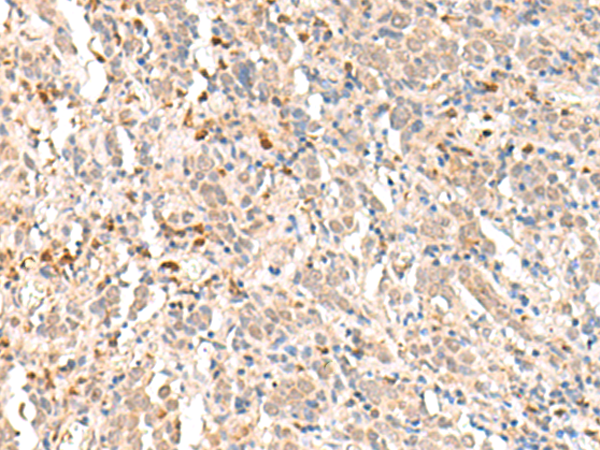 Immunohistochemistry of paraffin-embedded Human cervical cancer tissue  using RBM19 Polyclonal Antibody at dilution of 1:30(×200)