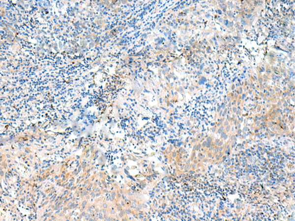 Immunohistochemistry of paraffin-embedded Human cervical cancer tissue  using NID2 Polyclonal Antibody at dilution of 1:50(×200)