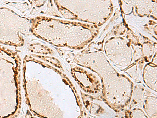 Immunohistochemistry of paraffin-embedded Human thyroid cancer tissue  using IPO11 Polyclonal Antibody at dilution of 1:65(×200)