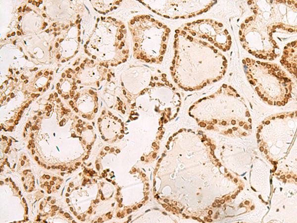 Immunohistochemistry of paraffin-embedded Human thyroid cancer tissue  using POM121 Polyclonal Antibody at dilution of 1:40(×200)