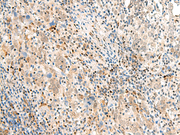 Immunohistochemistry of paraffin-embedded Human cervical cancer tissue  using POM121 Polyclonal Antibody at dilution of 1:40(×200)