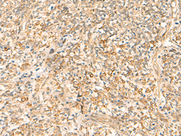 Immunohistochemistry of paraffin-embedded Human tonsil tissue  using EMC1 Polyclonal Antibody at dilution of 1:35(×200)