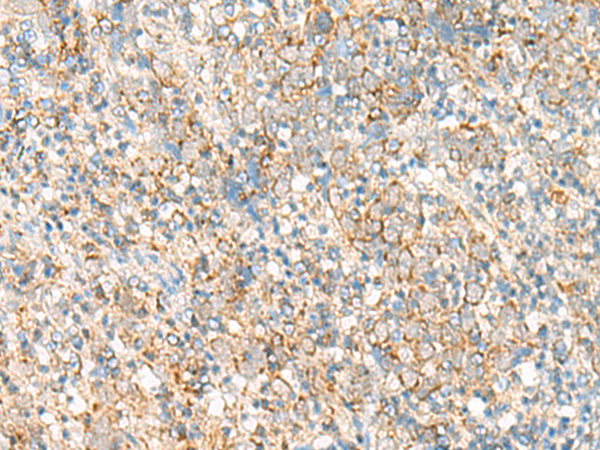 Immunohistochemistry of paraffin-embedded Human cervical cancer tissue  using PSD4 Polyclonal Antibody at dilution of 1:50(×200)