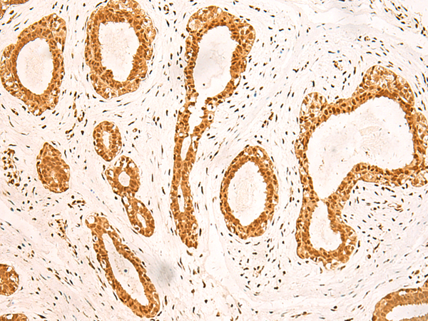 Immunohistochemistry of paraffin-embedded Human breast cancer tissue  using ZNF471 Polyclonal Antibody at dilution of 1:50(×200)