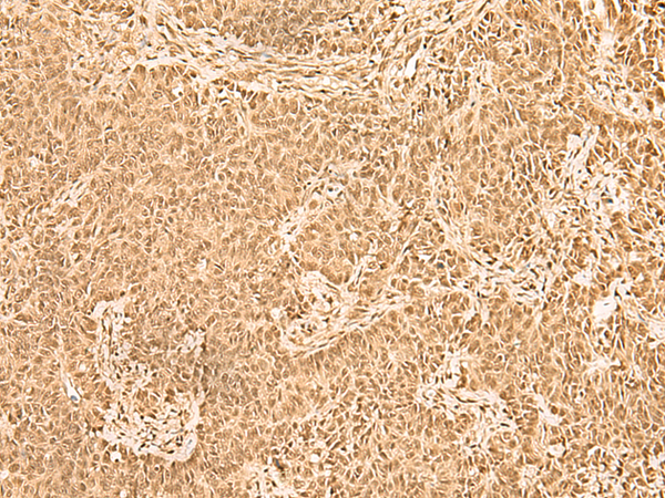 Immunohistochemistry of paraffin-embedded Human ovarian cancer tissue  using ZNF471 Polyclonal Antibody at dilution of 1:50(×200)