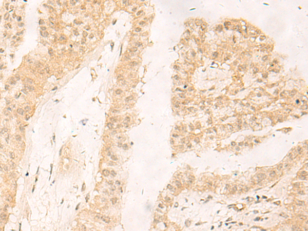 Immunohistochemistry of paraffin-embedded Human liver cancer tissue  using RBX1 Polyclonal Antibody at dilution of 1:30(×200)