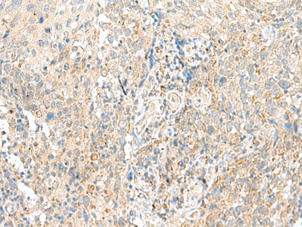 Immunohistochemistry of paraffin-embedded Human cervical cancer tissue  using SNRPD1 Polyclonal Antibody at dilution of 1:30(×200)