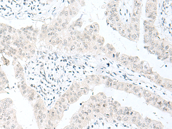 Immunohistochemistry of paraffin-embedded Human liver cancer tissue  using ENSA Polyclonal Antibody at dilution of 1:70(×200)