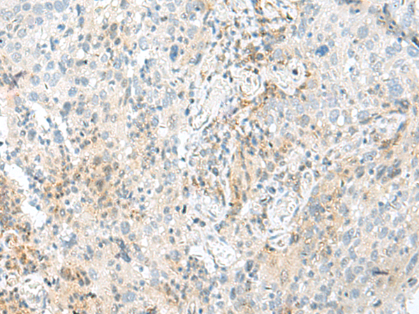 Immunohistochemistry of paraffin-embedded Human cervical cancer tissue  using ENSA Polyclonal Antibody at dilution of 1:70(×200)