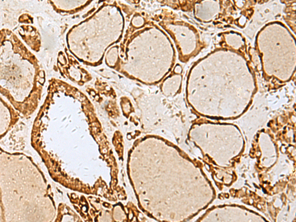 Immunohistochemistry of paraffin-embedded Human thyroid cancer tissue  using LYRM1 Polyclonal Antibody at dilution of 1:40(×200)