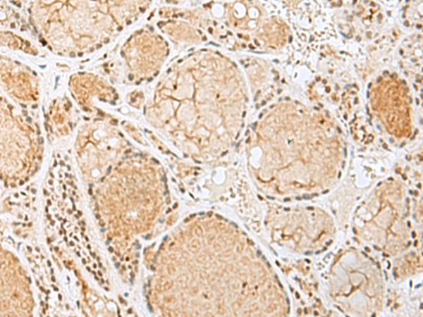 Immunohistochemistry of paraffin-embedded Human thyroid cancer tissue  using HIST1H2BK Polyclonal Antibody at dilution of 1:60(×200)