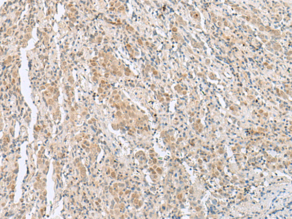 Immunohistochemistry of paraffin-embedded Human cervical cancer tissue  using HIST1H2BK Polyclonal Antibody at dilution of 1:60(×200)