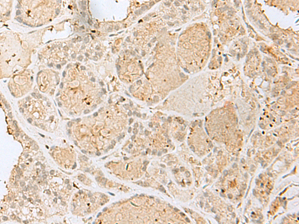 Immunohistochemistry of paraffin-embedded Human thyroid cancer tissue  using GOLGA7 Polyclonal Antibody at dilution of 1:40(×200)