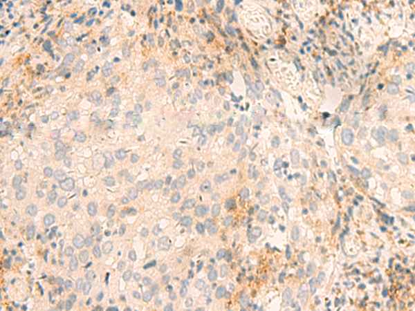 Immunohistochemistry of paraffin-embedded Human cervical cancer tissue  using GSKIP Polyclonal Antibody at dilution of 1:45(×200)