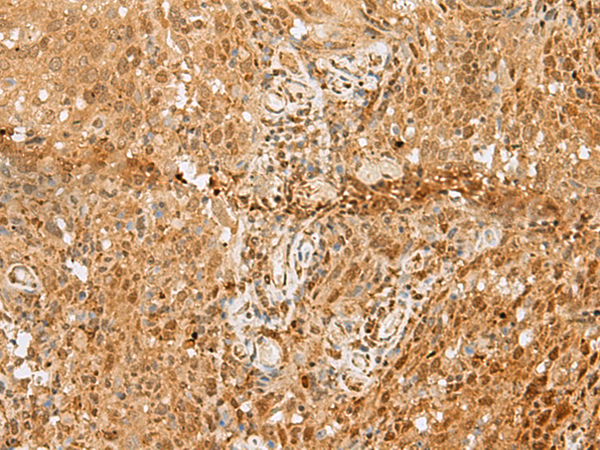 Immunohistochemistry of paraffin-embedded Human cervical cancer tissue  using PNRC2 Polyclonal Antibody at dilution of 1:50(×200)