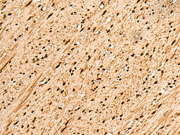 Immunohistochemistry of paraffin-embedded Human colorectal cancer tissue  using PNRC2 Polyclonal Antibody at dilution of 1:50(×200)